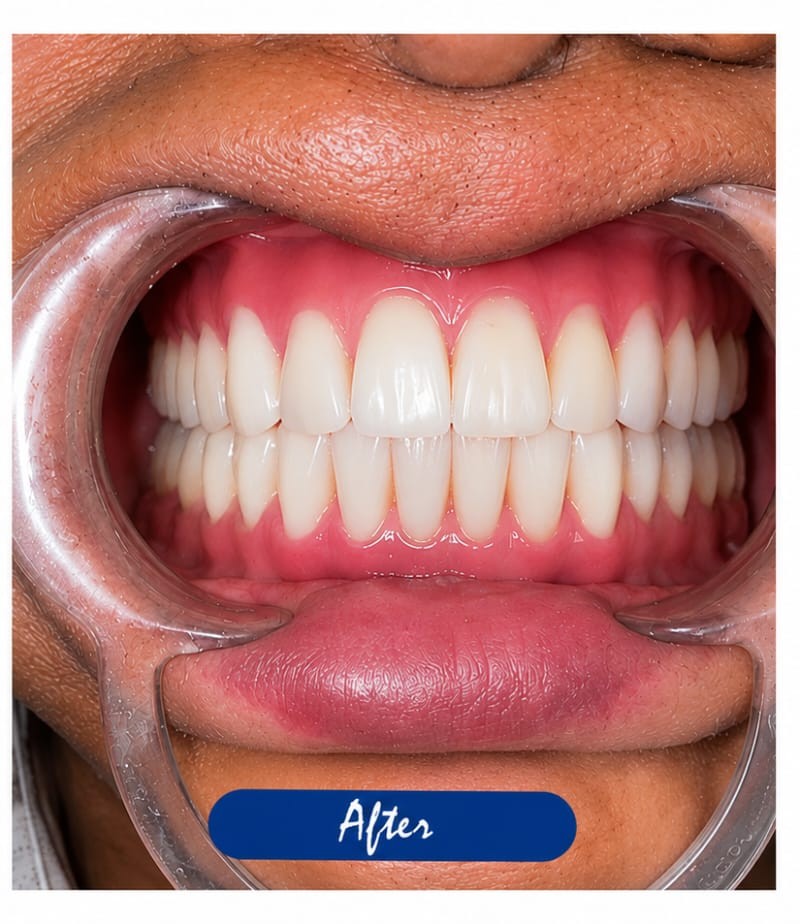 Dental Bridge & Implants — after treatment