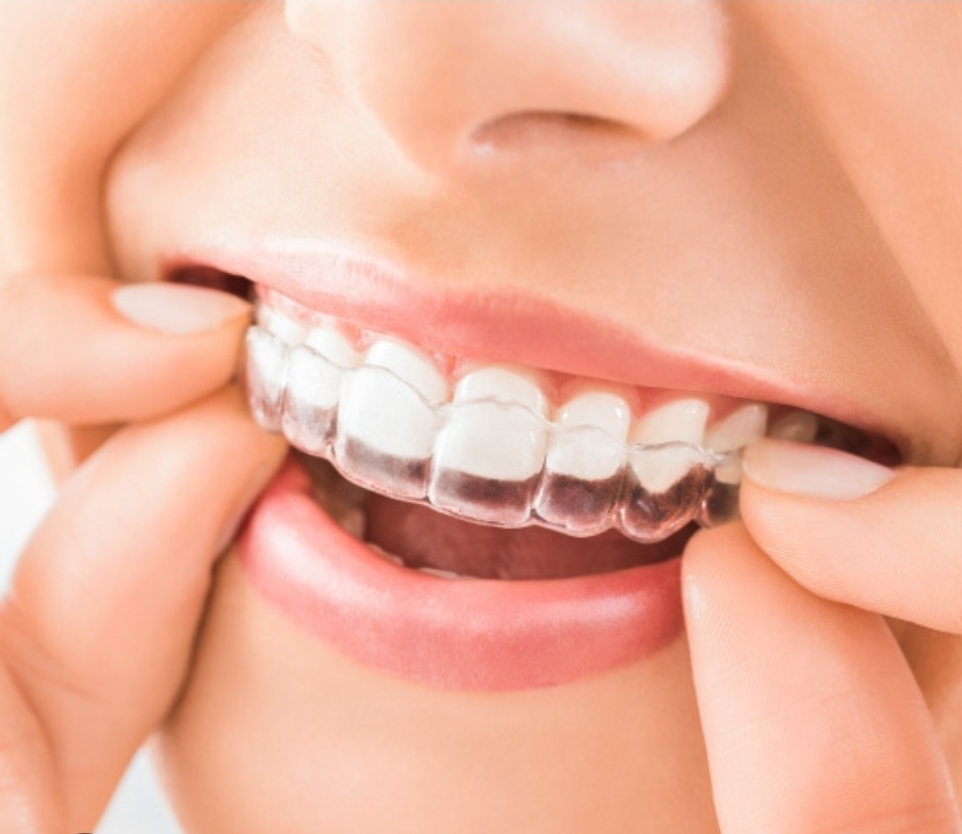 Clear Aligners — after treatment