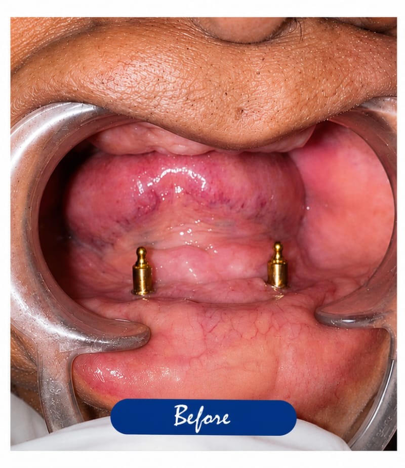 Dental Bridge & Implants — before treatment